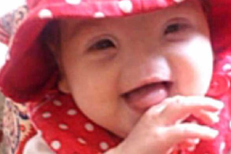 Orr nélkül született a kislány, operálnak neki orrot